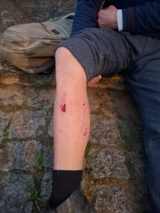 Servidor da prefeitura de Ibirama é atacado por pitbull durante coleta de lixo