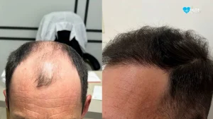 Transplante capilar transforma autoestima e já é realidade no Alto Vale com atendimento especializado