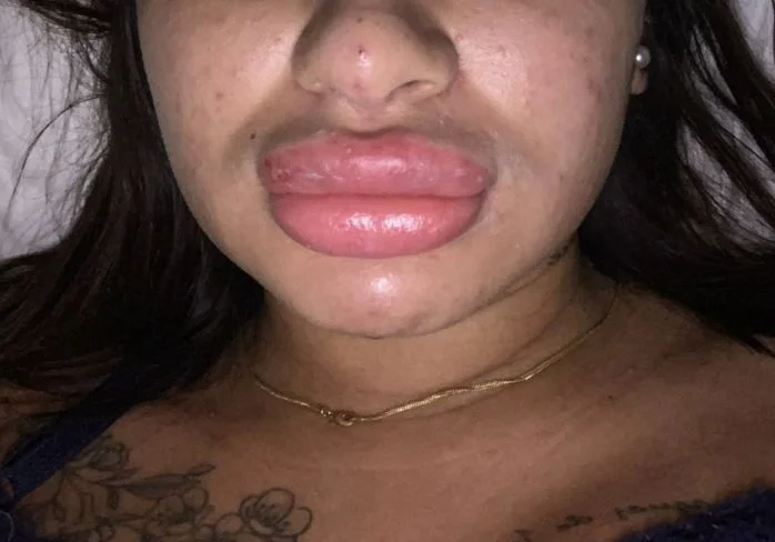 Polícia Civil indicia falsa biomédica que realizava procedimentos estéticos ilegais em SC