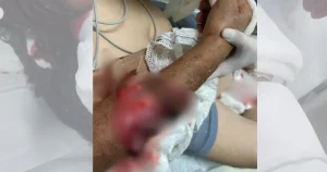 Idoso de 70 anos é atacado por pit bull durante leitura de medidor de energia em SC