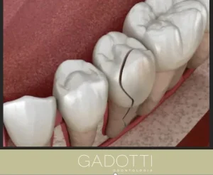 Fratura dental pode atingir nervos e exige atendimento imediato, alerta especialista